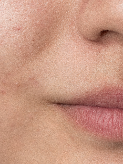 Pack Skincare Pele Propensa à Acne