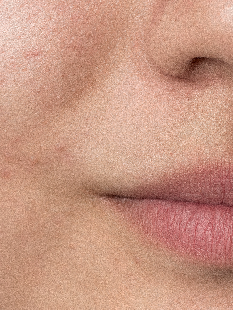 Pack Skincare Pele Propensa à Acne
